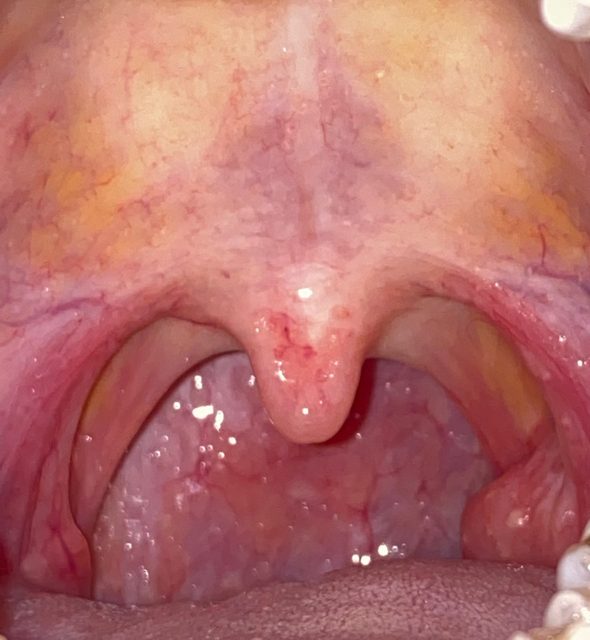 A clear throat photo: mouth open wide, bright light, the
                    back of the throat and both tonsils fully visible.